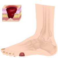 العناية بتقرحات القدم السكرية والجروح المزمنة
